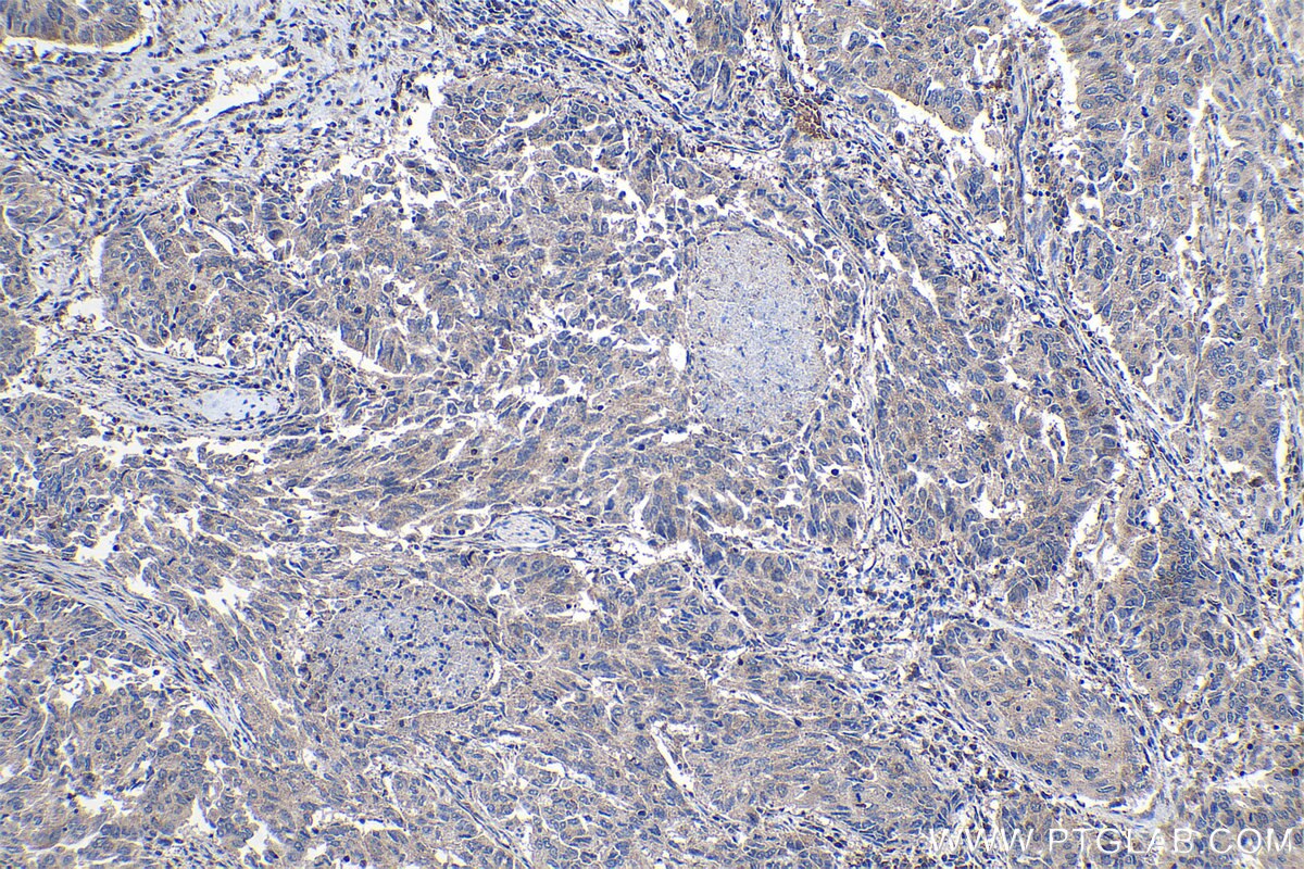 Immunohistochemical analysis of paraffin-embedded human lung cancer tissue slide using KHC1083 (DLEC1 IHC Kit).