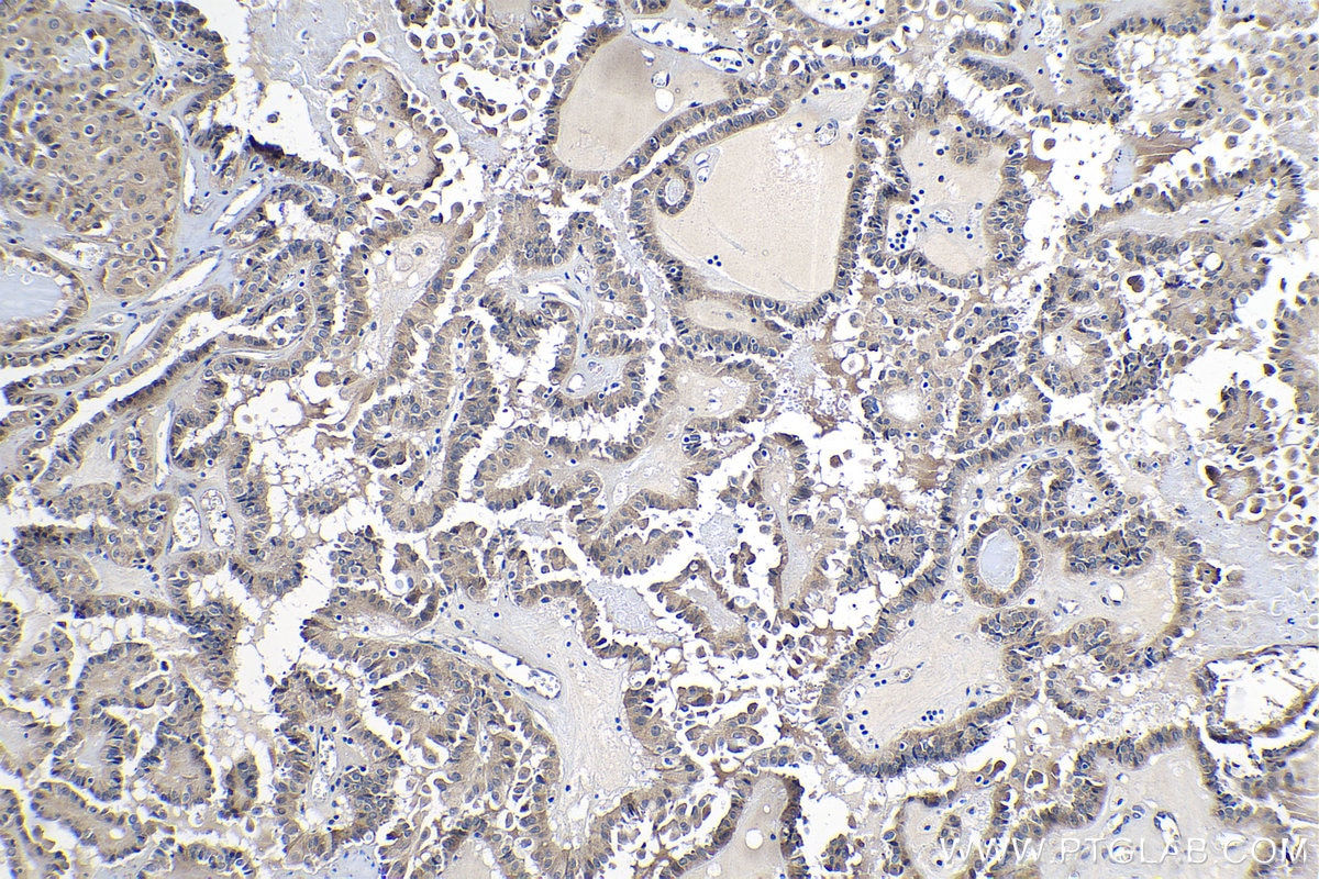 Immunohistochemical analysis of paraffin-embedded human thyroid cancer tissue slide using KHC1083 (DLEC1 IHC Kit).