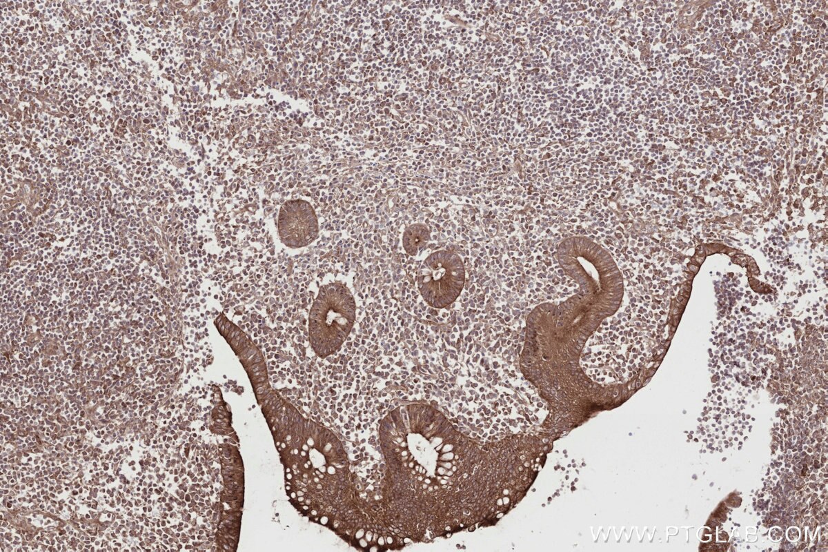 Immunohistochemical analysis of paraffin-embedded human appendicitis tissue slide using KHC2718 (DMXL2 IHC Kit).
