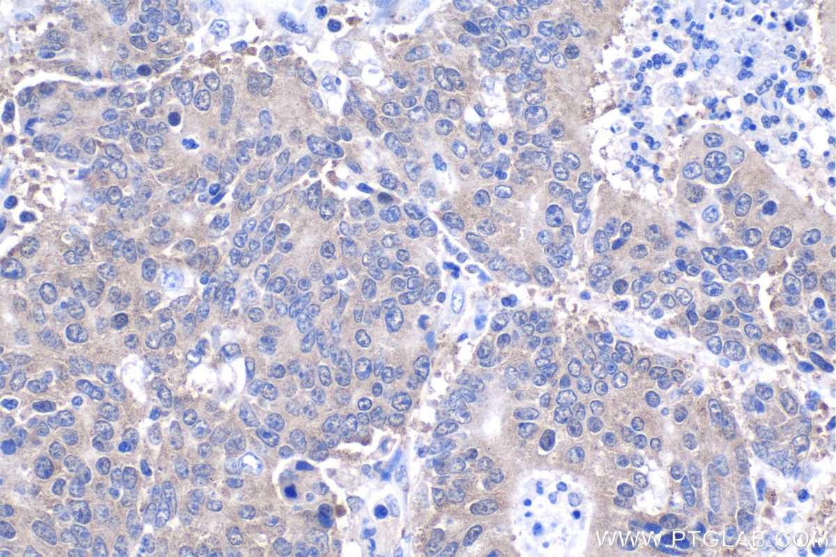 Immunohistochemical analysis of paraffin-embedded human colon cancer tissue slide using KHC1040 (DNAJA2 IHC Kit).