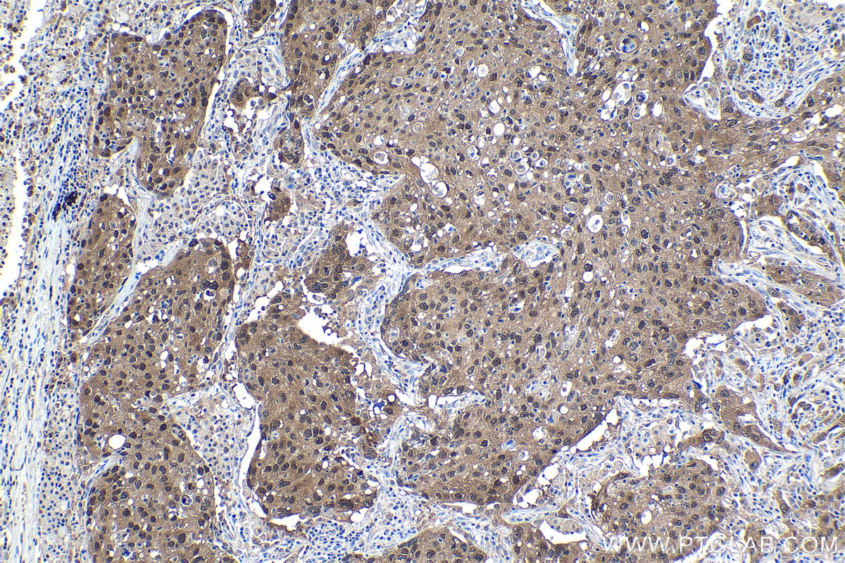 Immunohistochemical analysis of paraffin-embedded human lung cancer tissue slide using KHC1128 (DNAJB1 IHC Kit).