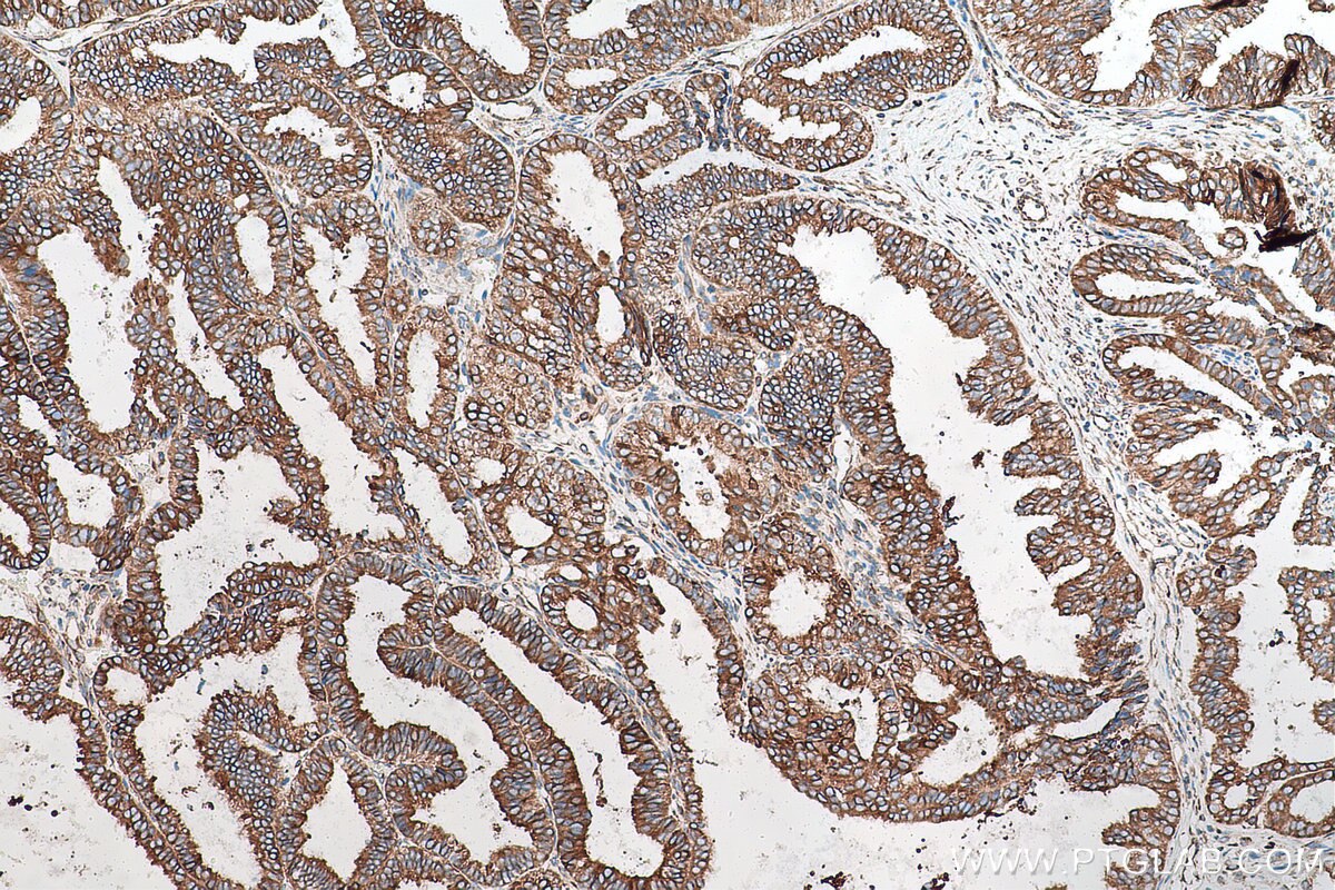 Immunohistochemical analysis of paraffin-embedded human ovary tumor tissue slide using KHC0936 (DNAJB11 IHC Kit).