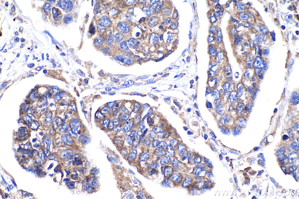 Immunohistochemical analysis of paraffin-embedded human stomach cancer tissue slide using KHC0936 (DNAJB11 IHC Kit).