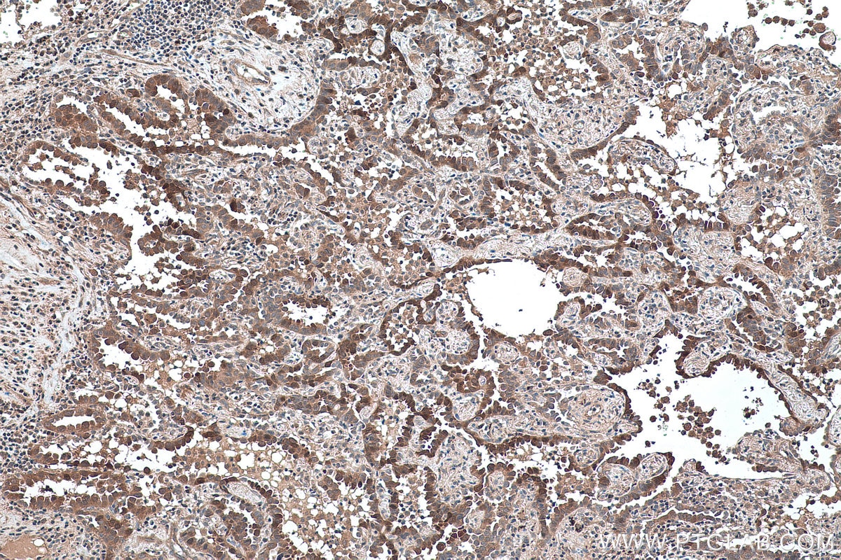 Immunohistochemical analysis of paraffin-embedded human lung cancer tissue slide using KHC0414 (DNAJC12 IHC Kit).
