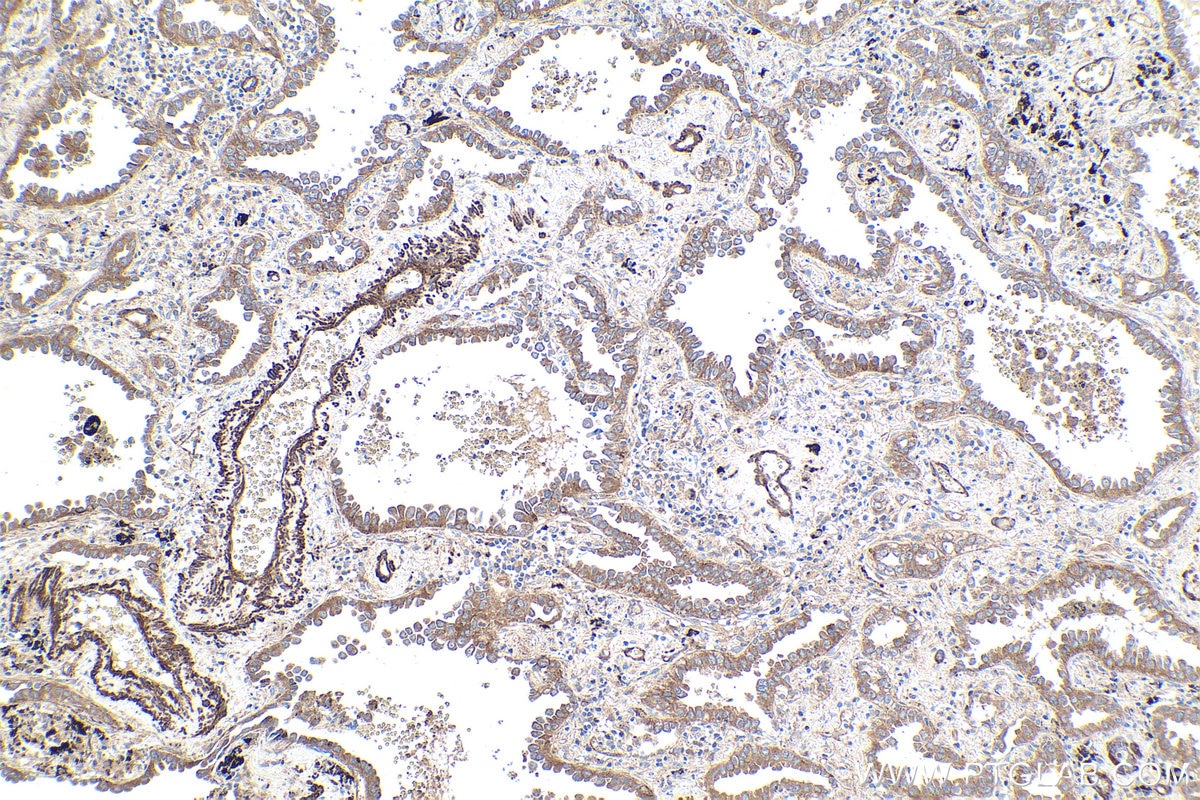 Immunohistochemical analysis of paraffin-embedded human lung cancer tissue slide using KHC1890 (DNAJC2/ZRF1 IHC Kit).