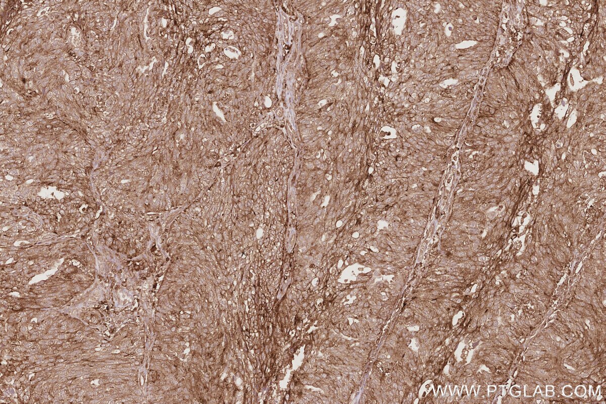 Immunohistochemical analysis of paraffin-embedded human ovary cancer tissue slide using KHC2914 (DNAJC5 IHC Kit).