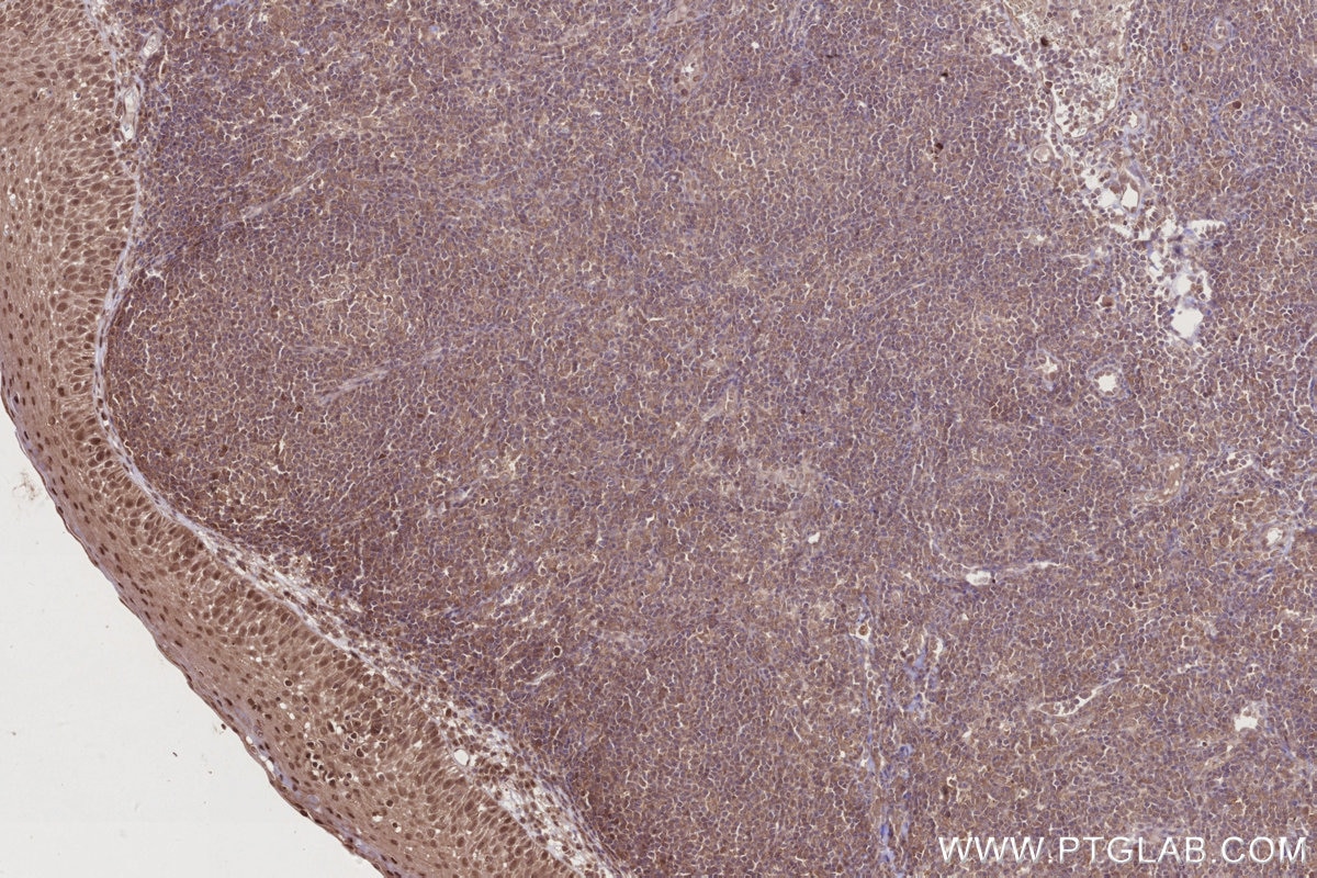 Immunohistochemical analysis of paraffin-embedded human tonsillitis tissue slide using KHC2780 (DOCK10 IHC Kit).