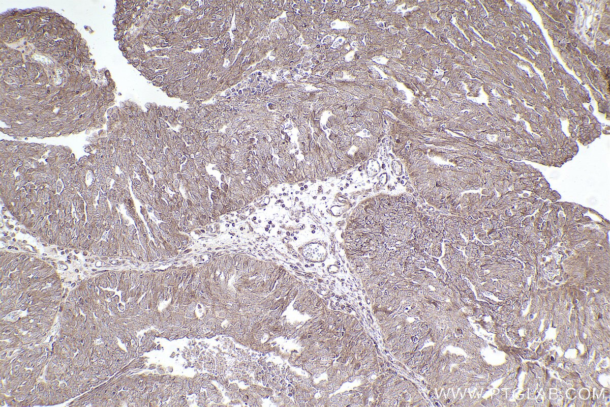 Immunohistochemical analysis of paraffin-embedded human ovary cancer tissue slide using KHC2544 (DOCK11 IHC Kit).