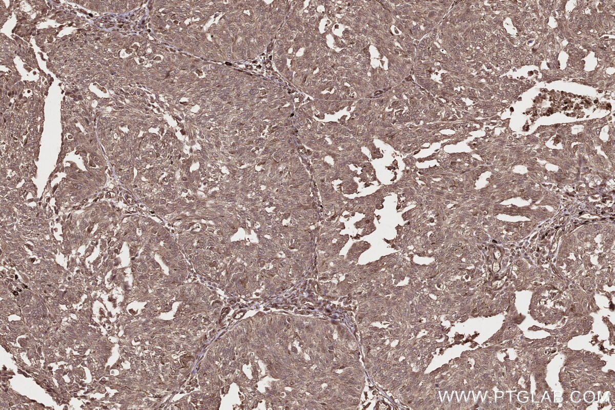 Immunohistochemical analysis of paraffin-embedded human ovary cancer tissue slide using KHC2663 (DOCK3 IHC Kit).