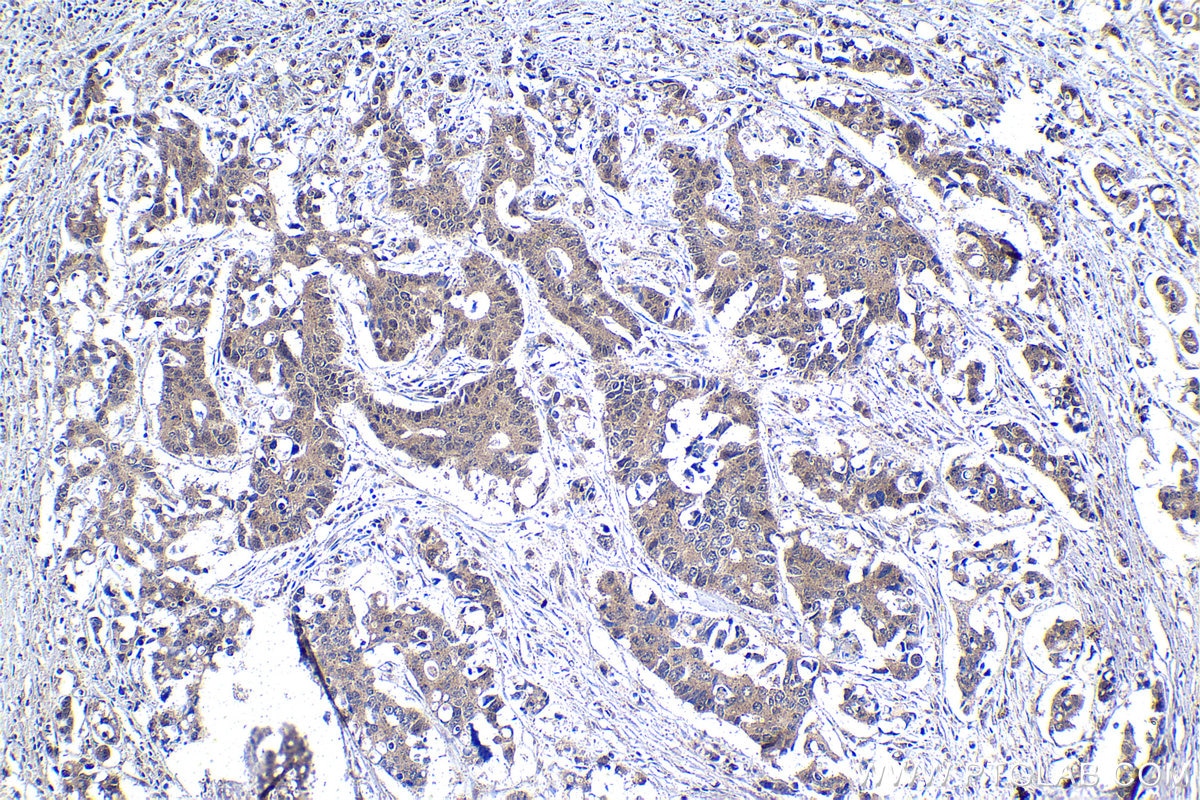 Immunohistochemical analysis of paraffin-embedded human stomach cancer tissue slide using KHC1855 (DPF2 IHC Kit).