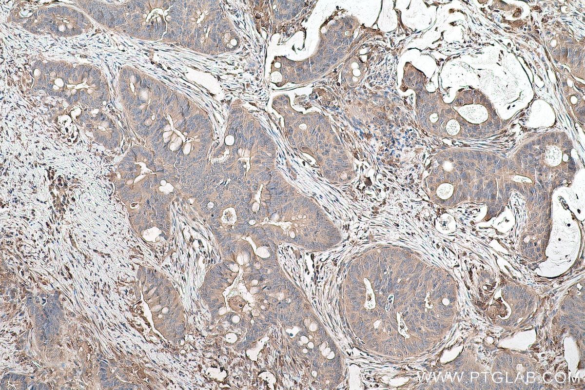 Immunohistochemical analysis of paraffin-embedded human colon cancer tissue slide using KHC0824 (DPYD IHC Kit).