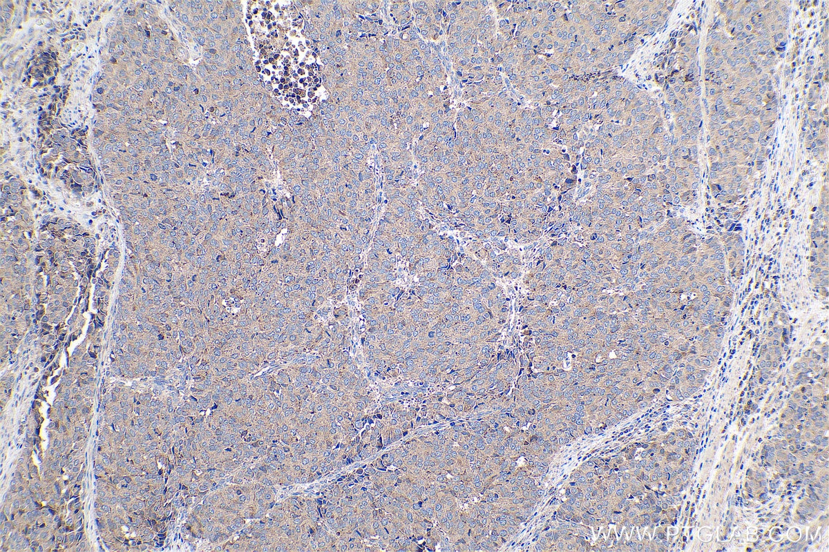 Immunohistochemical analysis of paraffin-embedded human stomach cancer tissue slide using KHC0731 (DPYSL2 IHC Kit).