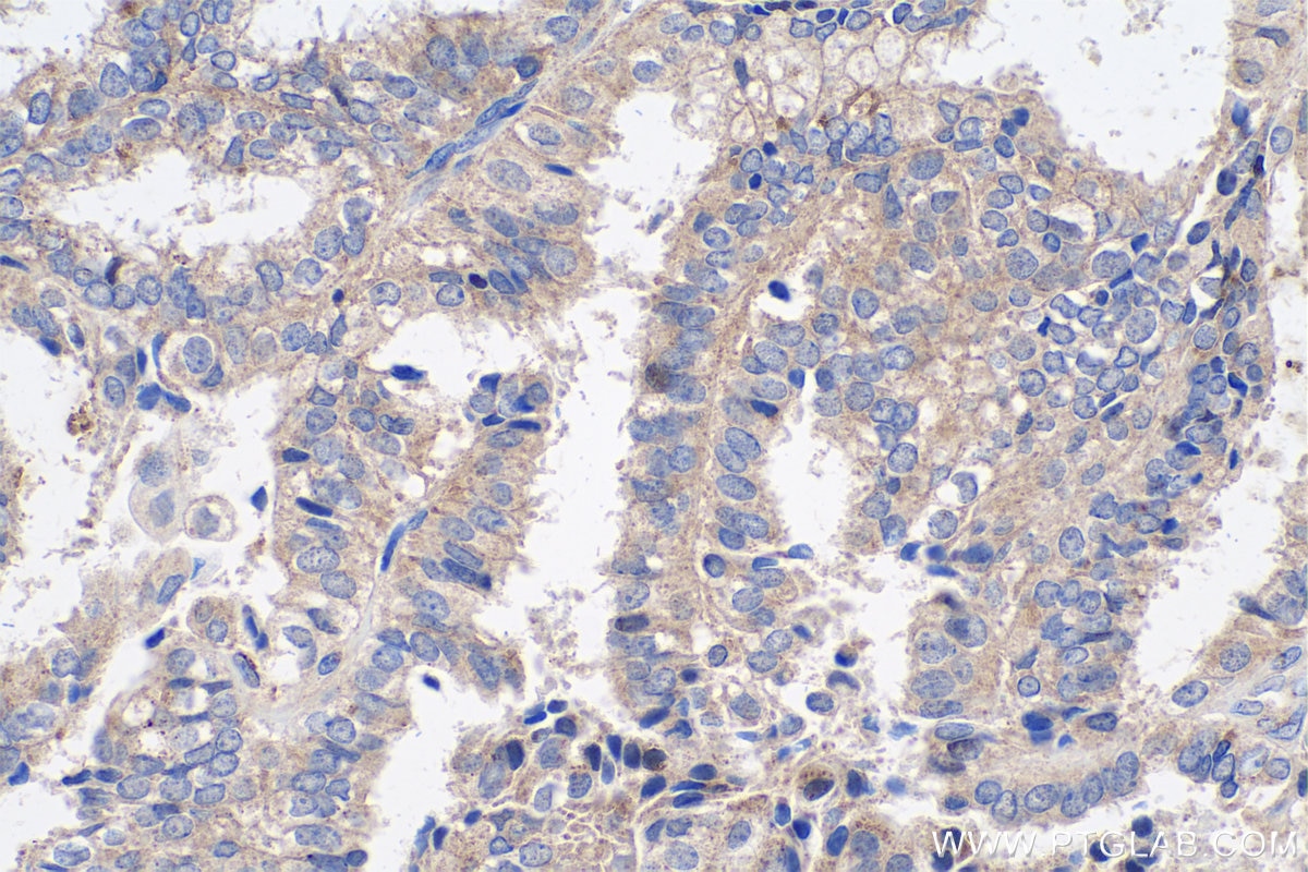 Immunohistochemical analysis of paraffin-embedded human ovary tumor tissue slide using KHC0731 (DPYSL2 IHC Kit).
