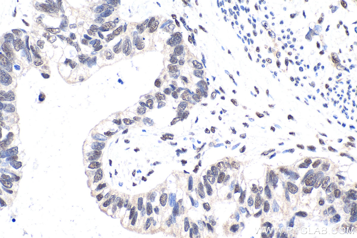 Immunohistochemical analysis of paraffin-embedded human urothelial carcinoma tissue slide using KHC1739 (DRAP1 IHC Kit).