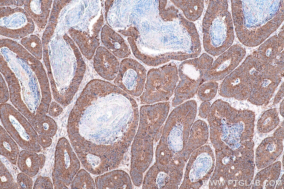 Immunohistochemical analysis of paraffin-embedded human colon cancer tissue slide using KHC0822 (DRG1 IHC Kit).