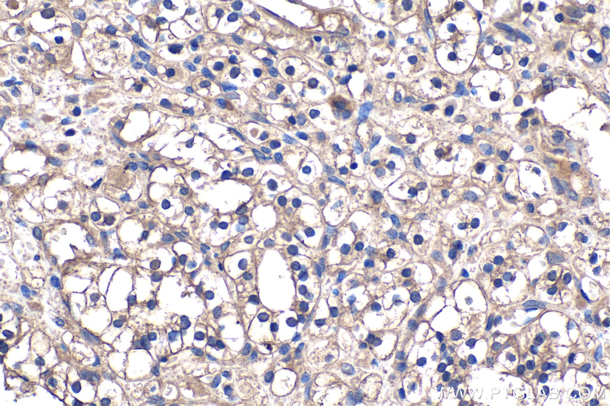 Immunohistochemical analysis of paraffin-embedded human renal cell carcinoma tissue slide using KHC1340 (DSE IHC Kit).