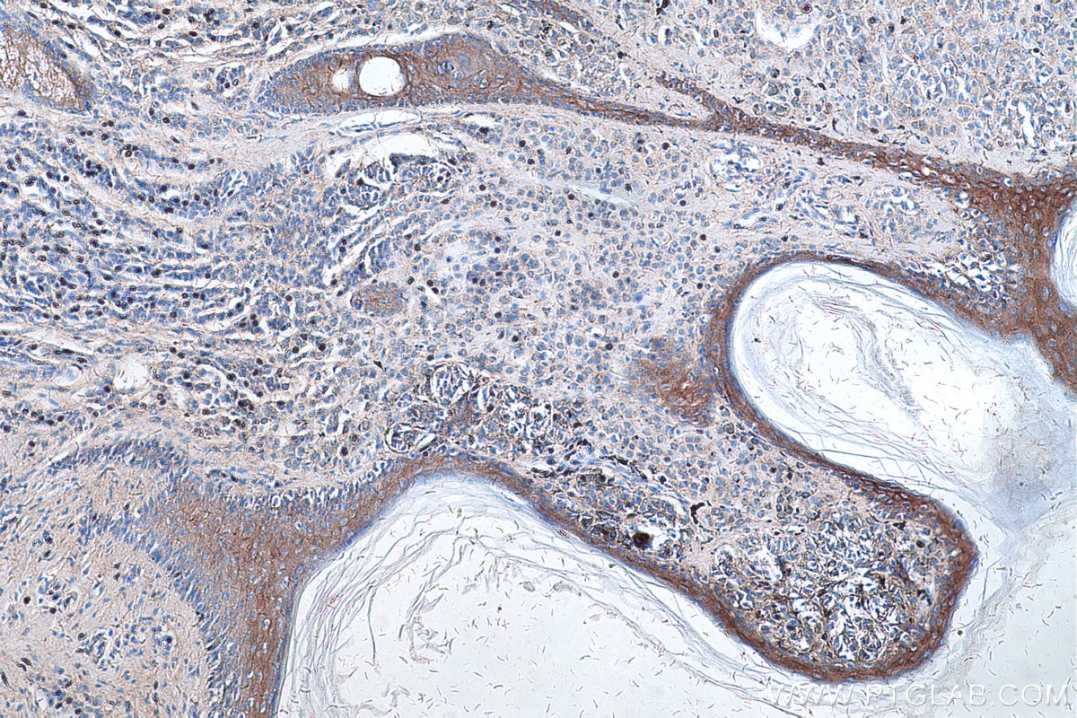 Immunohistochemical analysis of paraffin-embedded human malignant melanoma tissue slide using KHC0259 (DSG1 IHC Kit).