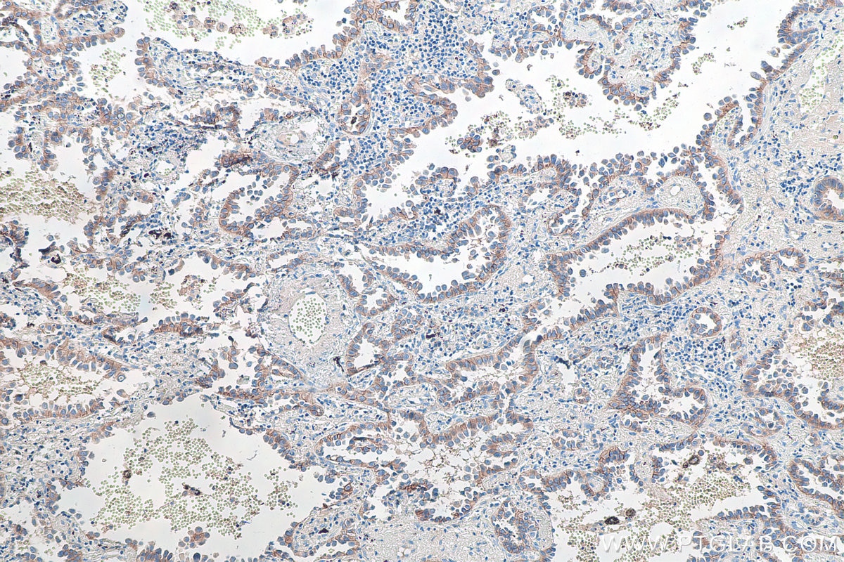 Immunohistochemical analysis of paraffin-embedded human lung cancer tissue slide using KHC0105 (DSG2 IHC Kit).