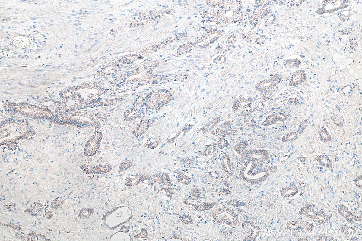 Immunohistochemical analysis of paraffin-embedded human prostate cancer tissue slide using KHC0105 (DSG2 IHC Kit).