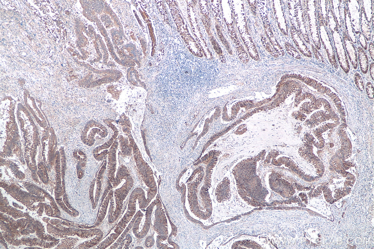 Immunohistochemical analysis of paraffin-embedded human colon cancer tissue slide using KHC0105 (DSG2 IHC Kit).