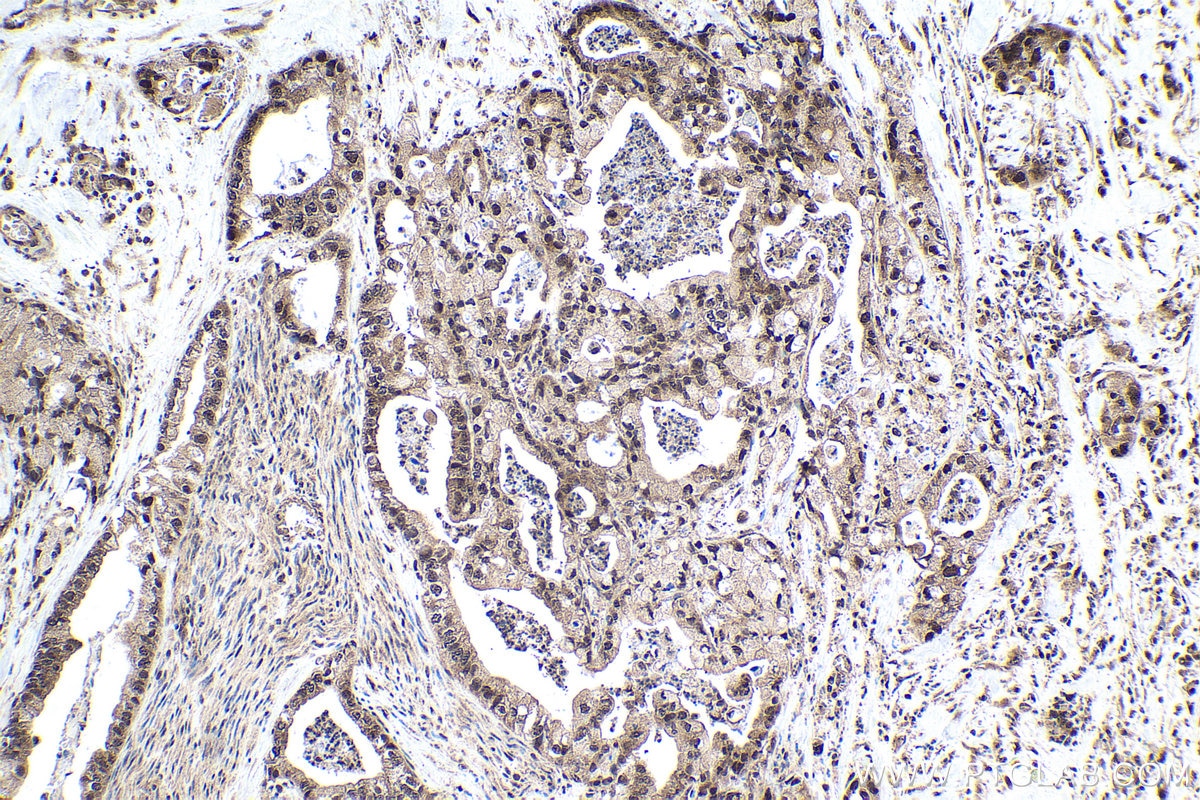 Immunohistochemical analysis of paraffin-embedded human pancreas cancer tissue slide using KHC1637 (DSS1 IHC Kit).