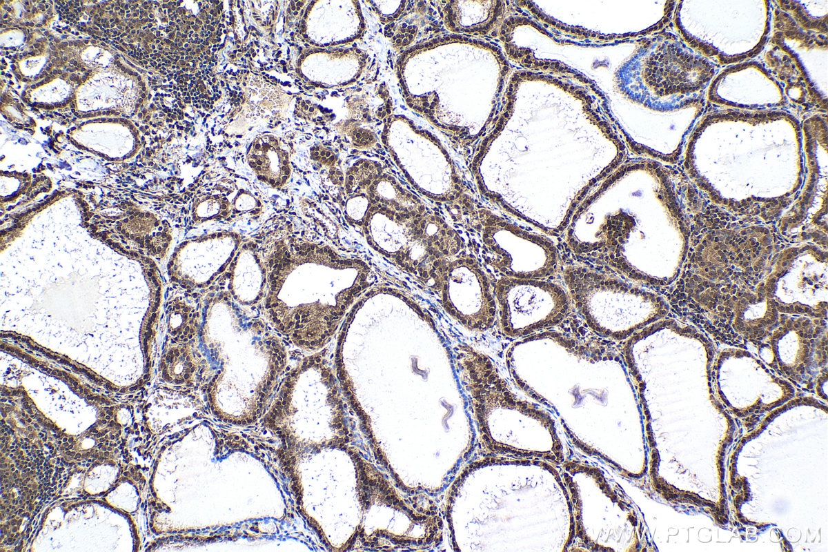 Immunohistochemical analysis of paraffin-embedded human thyroid cancer tissue slide using KHC1637 (DSS1 IHC Kit).