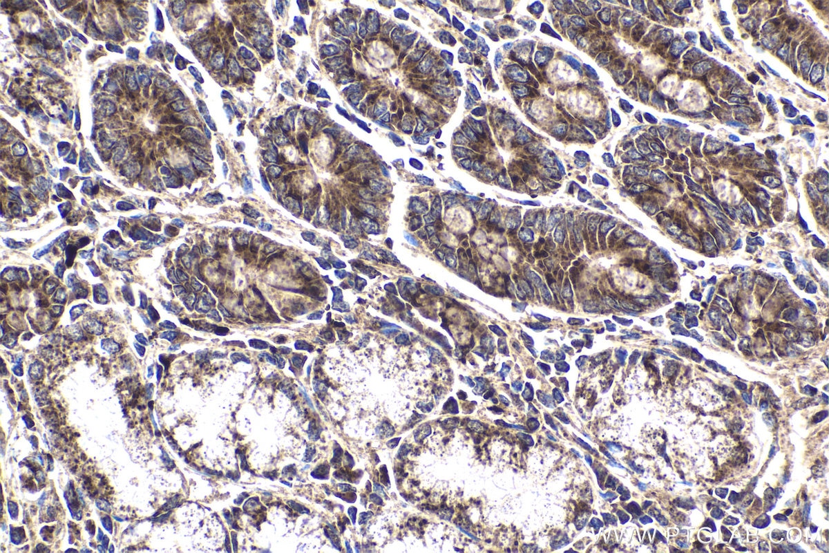 Immunohistochemical analysis of paraffin-embedded human stomach cancer tissue slide using KHC1811 (DTX1 IHC Kit).