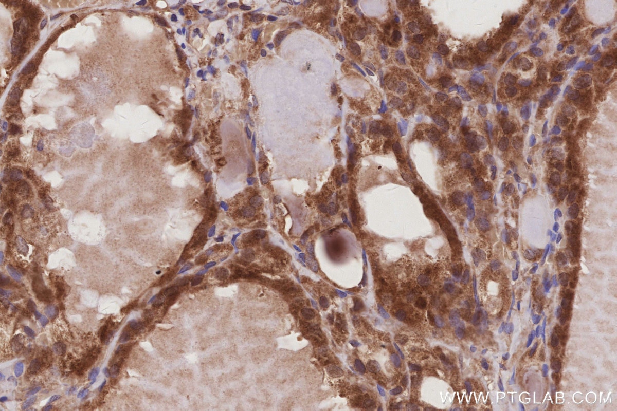 Immunohistochemical analysis of paraffin-embedded human thyroid cancer tissue slide using KHC3014 (DUSP13 IHC Kit).