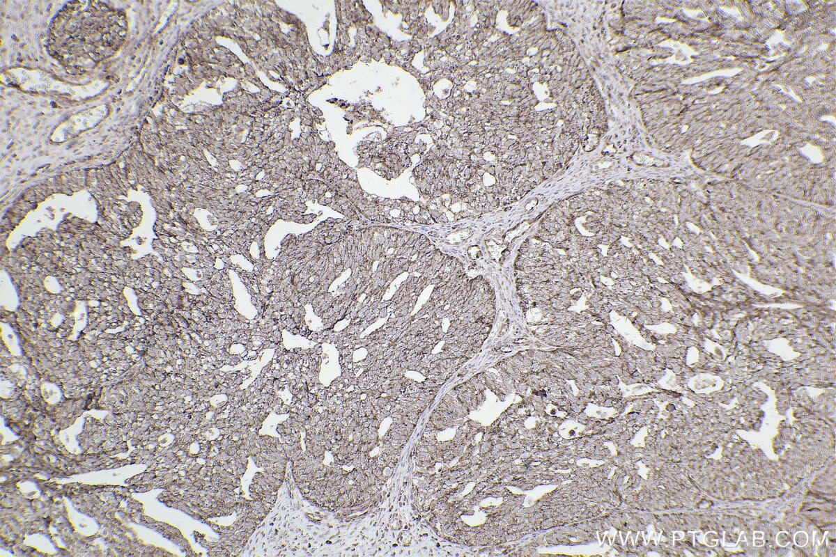 Immunohistochemical analysis of paraffin-embedded human ovary cancer tissue slide using KHC2521 (DUSP6 IHC Kit).
