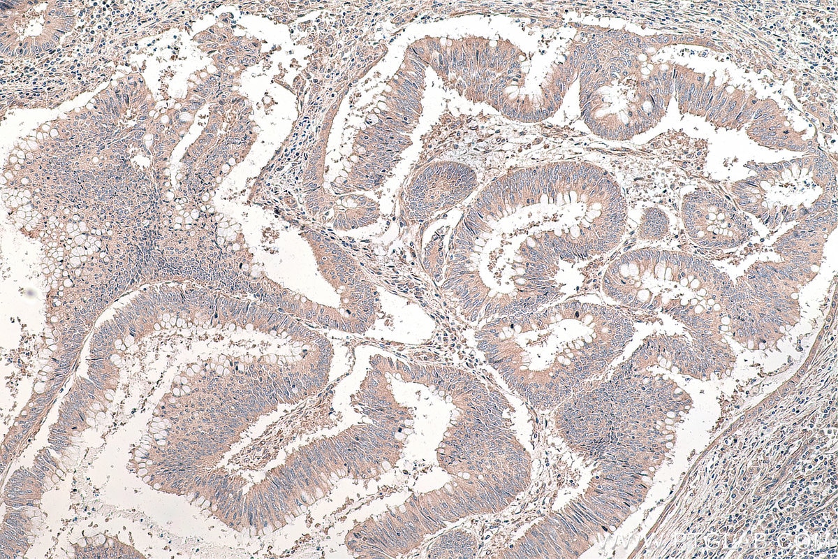 Immunohistochemical analysis of paraffin-embedded human colon cancer tissue slide using KHC0125 (DVL3 IHC Kit).