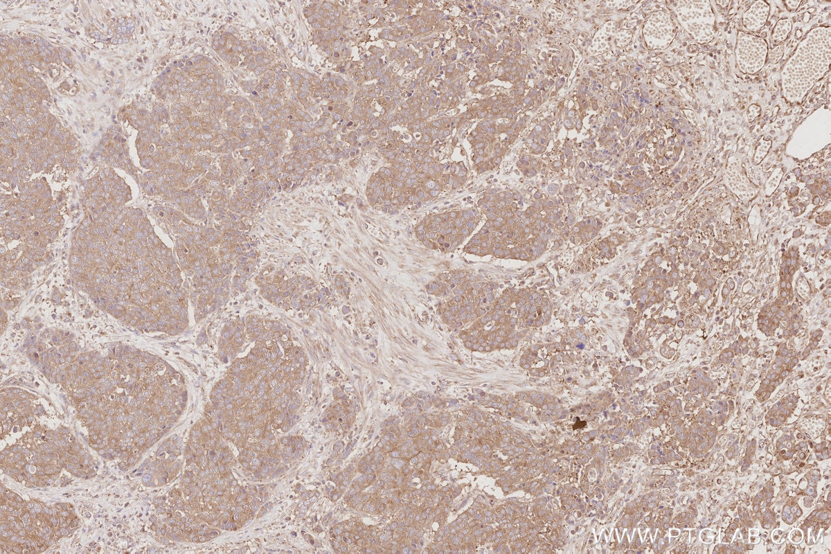 Immunohistochemical analysis of paraffin-embedded human stomach cancer tissue slide using KHC3091 (DYNC1LI1 IHC Kit).