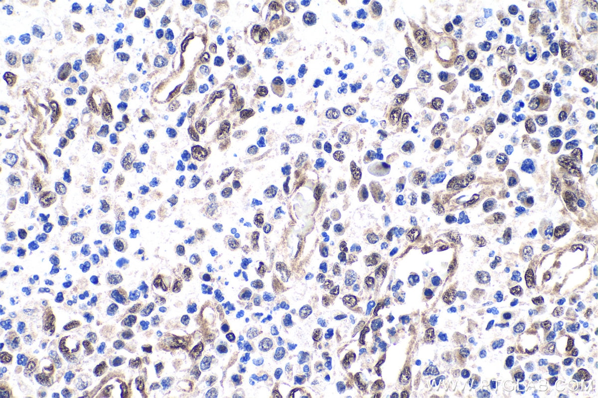 Immunohistochemical analysis of paraffin-embedded human colon cancer tissue slide using KHC0975 (DYNLL1 IHC Kit).
