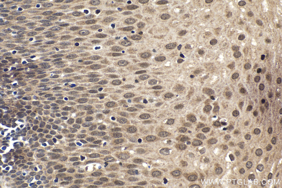 Immunohistochemical analysis of paraffin-embedded human oesophagus cancer tissue slide using KHC1812 (DZIP1 IHC Kit).