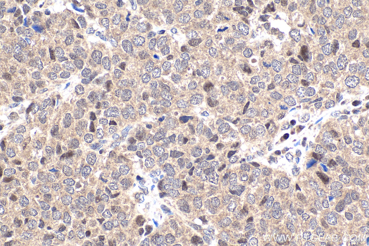 Immunohistochemical analysis of paraffin-embedded human stomach cancer tissue slide using KHC1812 (DZIP1 IHC Kit).