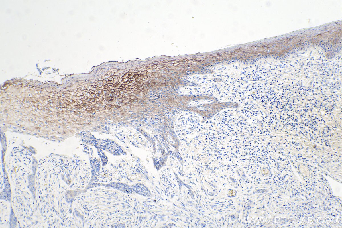 Immunohistochemical analysis of paraffin-embedded human skin cancer tissue slide using KHC0091 (Desmocollin 2 IHC Kit).