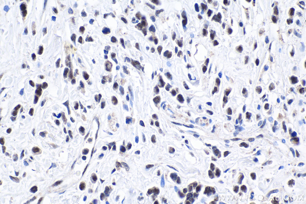 Immunohistochemical analysis of paraffin-embedded human stomach cancer tissue slide using KHC1877 (EAF1 IHC Kit).