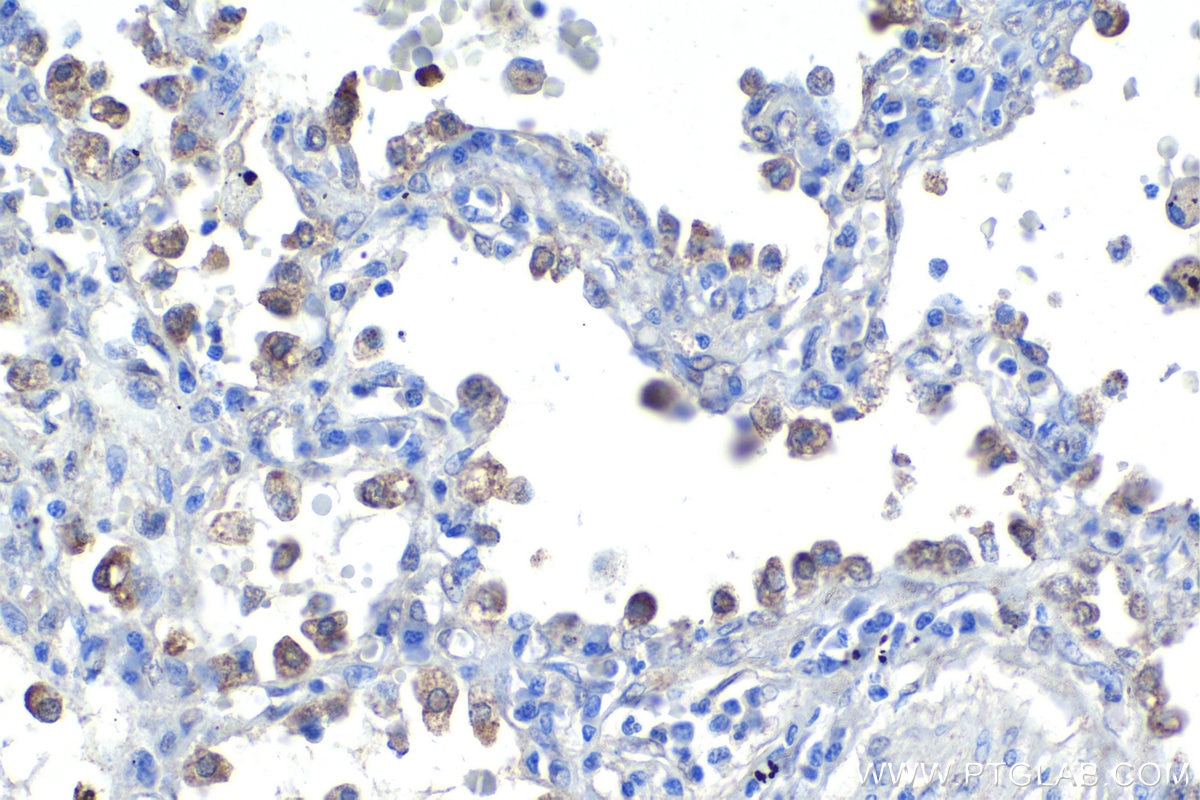 Immunohistochemical analysis of paraffin-embedded human lung cancer tissue slide using KHC1753 (ECE1 IHC Kit).