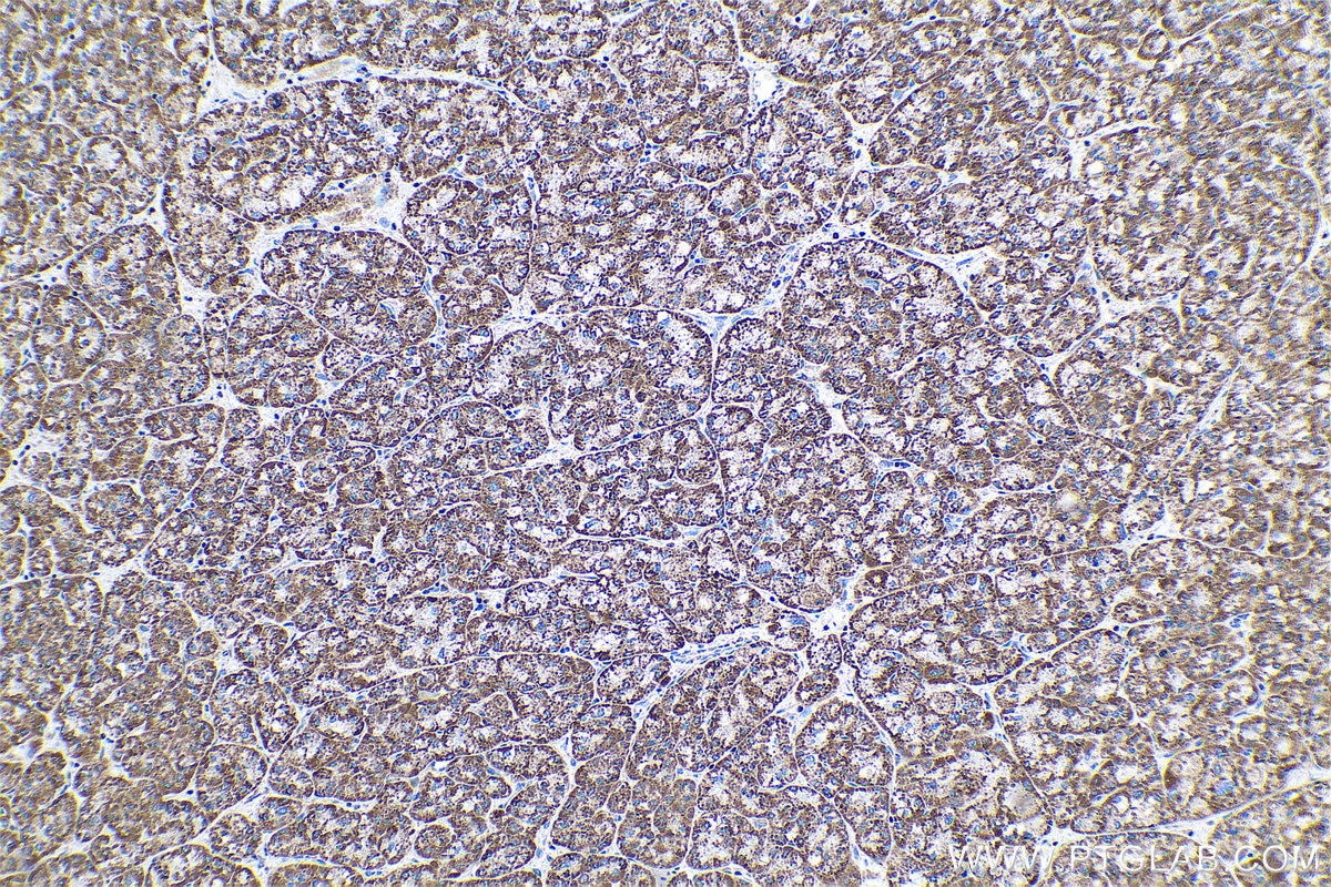 Immunohistochemical analysis of paraffin-embedded human liver cancer tissue slide using KHC0589 (ECH1 IHC Kit).