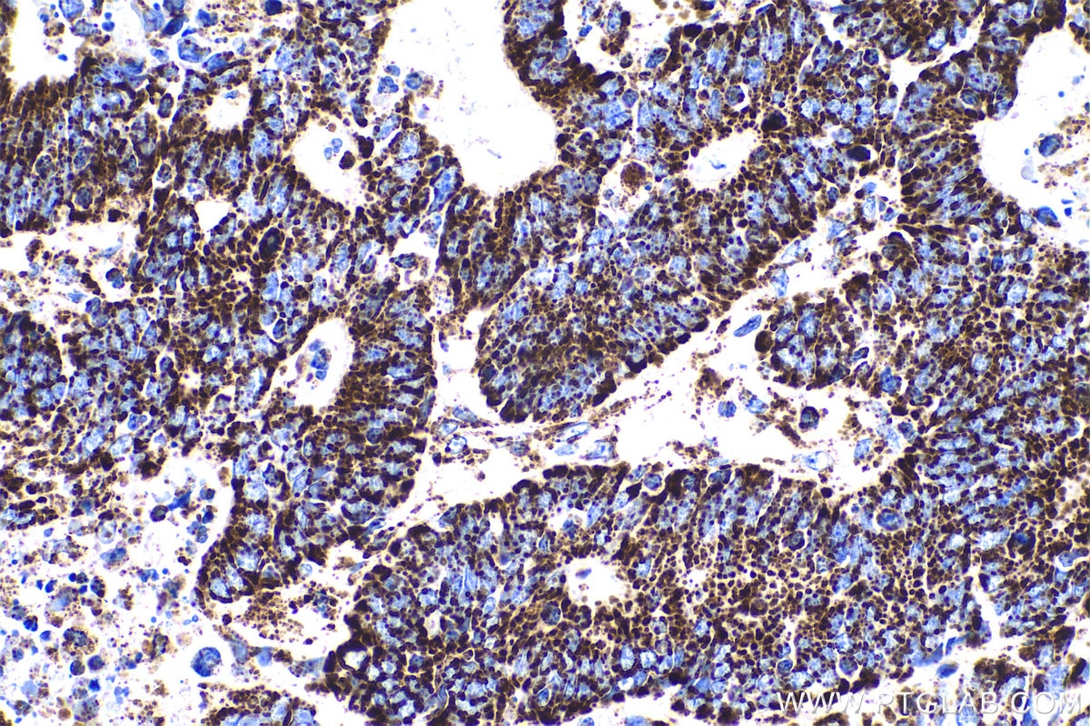 Immunohistochemical analysis of paraffin-embedded human colon cancer tissue slide using KHC0589 (ECH1 IHC Kit).