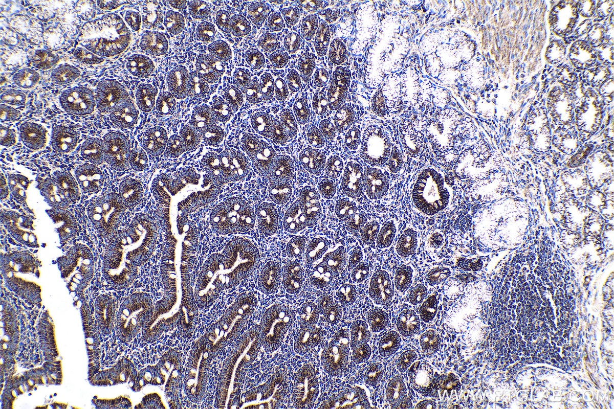 Immunohistochemical analysis of paraffin-embedded human stomach cancer tissue slide using KHC0589 (ECH1 IHC Kit).