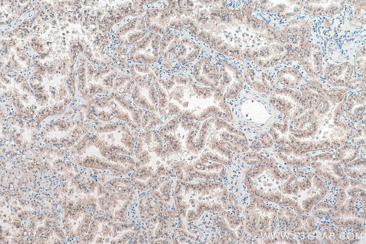Immunohistochemical analysis of paraffin-embedded human lung cancer tissue slide using KHC0933 (ECHDC1 IHC Kit).