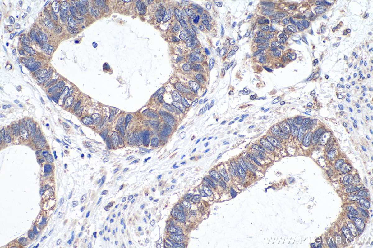 Immunohistochemical analysis of paraffin-embedded human urothelial carcinoma tissue slide using KHC0933 (ECHDC1 IHC Kit).