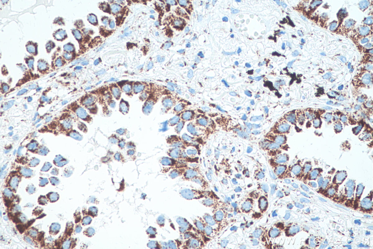 Immunohistochemical analysis of paraffin-embedded human lung cancer tissue slide using KHC0514 (ECHS1 IHC Kit).