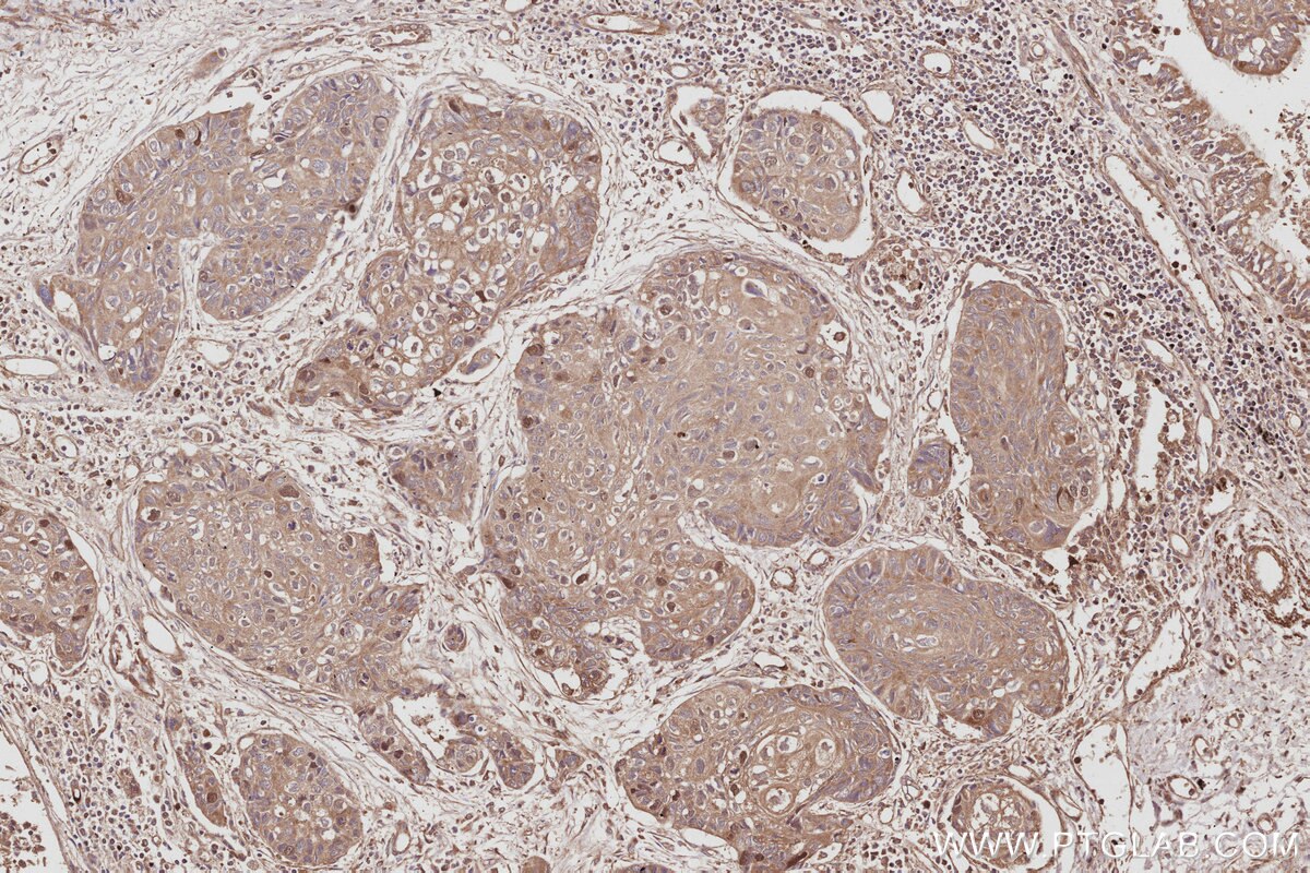 Immunohistochemical analysis of paraffin-embedded human lung cancer tissue slide using KHC2964 (ECT2 IHC Kit).