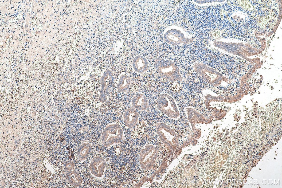 Immunohistochemical analysis of paraffin-embedded human appendicitis tissue slide using KHC0996 (EDC4 IHC Kit).