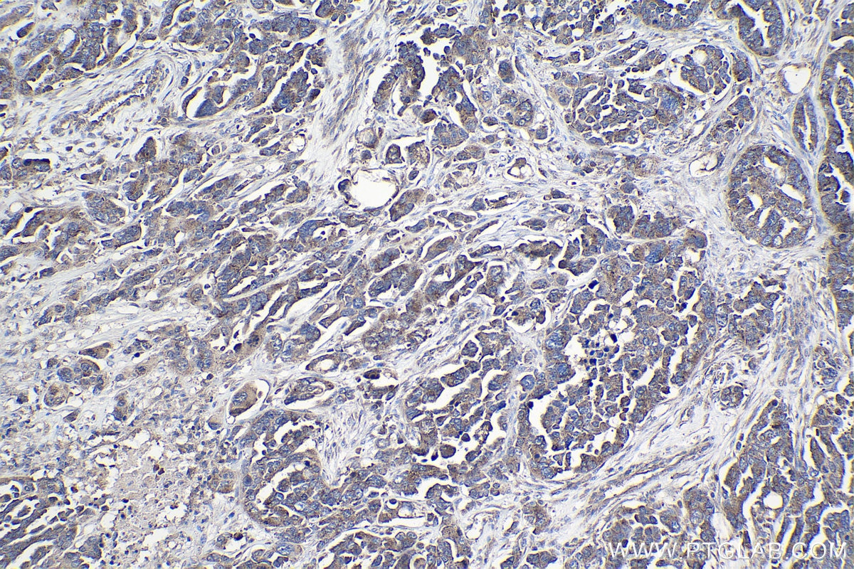 Immunohistochemical analysis of paraffin-embedded human colon cancer tissue slide using KHC0996 (EDC4 IHC Kit).