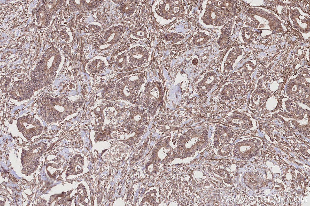 Immunohistochemical analysis of paraffin-embedded human rectal cancer tissue slide using KHC2749 (EDEM1 IHC Kit).