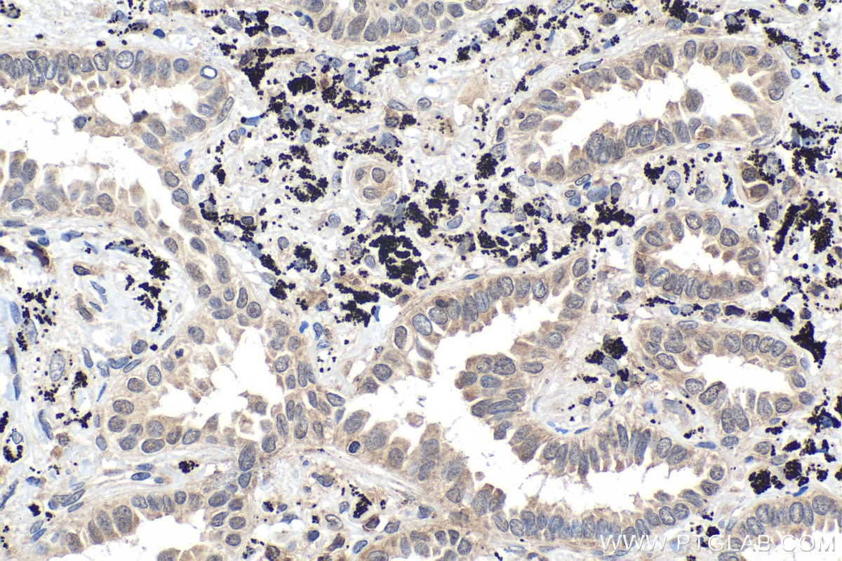 Immunohistochemical analysis of paraffin-embedded human lung cancer tissue slide using KHC1469 (EDF1 IHC Kit).