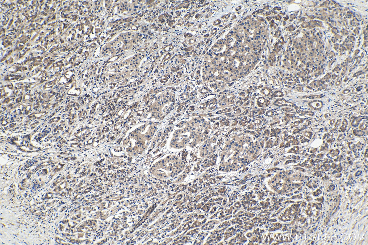 Immunohistochemical analysis of paraffin-embedded human pancreas cancer tissue slide using KHC1469 (EDF1 IHC Kit).