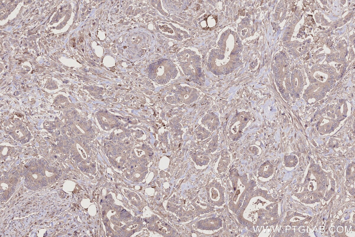 Immunohistochemical analysis of paraffin-embedded human rectal cancer tissue slide using KHC2751 (EDG2/LPAR1 IHC Kit).